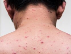 Gejala Virus Cacar Monyet, Fase Awal hingga Infeksius